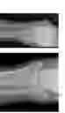 Fig. 35 - Intramedullary fracture fixation devices and methods