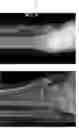 Fig. 36 - Intramedullary fracture fixation devices and methods