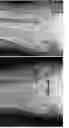 Fig. 37 - Intramedullary fracture fixation devices and methods