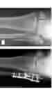 Fig. 38 - Intramedullary fracture fixation devices and methods