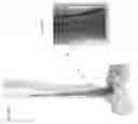 Fig. 68 - Intramedullary fracture fixation devices and methods