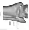 Fig. 69 - Intramedullary fracture fixation devices and methods