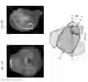 Fig. 70 - Intramedullary fracture fixation devices and methods