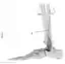 Fig. 71 - Intramedullary fracture fixation devices and methods