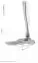 Fig. 76 - Intramedullary fracture fixation devices and methods