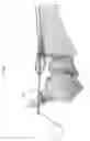 Fig. 77 - Intramedullary fracture fixation devices and methods