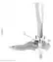 Fig. 82 - Intramedullary fracture fixation devices and methods