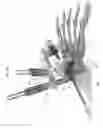 Fig. 84 - Intramedullary fracture fixation devices and methods