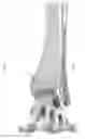 Fig. 89 - Intramedullary fracture fixation devices and methods