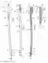 Fig. 06 - Intramedullary rod for pivoting a fastener
