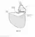 Fig. 07 - Electrosurgical tissue and vessel sealing device
