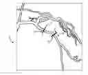Fig. 01 - Treatment planning for a stenosis in a vascular segment based on virtual hemodynamic analysis
