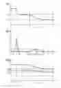 Fig. 04 - Treatment planning for a stenosis in a vascular segment based on virtual hemodynamic analysis