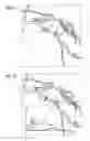 Fig. 06 - Treatment planning for a stenosis in a vascular segment based on virtual hemodynamic analysis