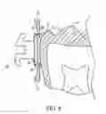 Fig. 09 - Orthodontic brackets for deciduous teeth