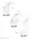Fig. 33 - Variable depth surgical fixation