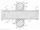 Fig. 01 - Stent including displacement capabilities