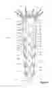 Fig. 03 - Temporary diameter reduction constraint arrangement for a stent graft in combination with a stent graft