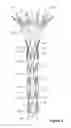 Fig. 04 - Temporary diameter reduction constraint arrangement for a stent graft in combination with a stent graft