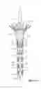 Fig. 06 - Temporary diameter reduction constraint arrangement for a stent graft in combination with a stent graft