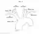Fig. 05 - Vessel access catheter