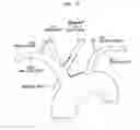 Fig. 06 - Vessel access catheter