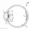 Fig. 01 - Accommodating intraocular lenses and methods of use