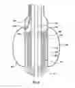 Fig. 09 - Valve delivery system having an integral displacement component for managing chordae tendineae in situ and methods of use thereof