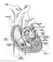 Fig. 02 - Methods of delivery of heart valves