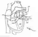 Fig. 01 - Mitral value prosthesis with atrial anchoring