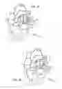 Fig. 04 - Mitral value prosthesis with atrial anchoring