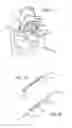 Fig. 06 - Mitral value prosthesis with atrial anchoring