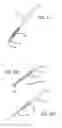 Fig. 10 - Mitral value prosthesis with atrial anchoring