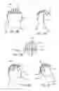Fig. 13 - Mitral value prosthesis with atrial anchoring