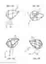 Fig. 14 - Mitral value prosthesis with atrial anchoring