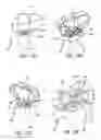 Fig. 16 - Mitral value prosthesis with atrial anchoring