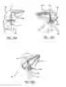 Fig. 17 - Mitral value prosthesis with atrial anchoring