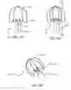 Fig. 19 - Mitral value prosthesis with atrial anchoring