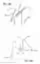Fig. 22 - Mitral value prosthesis with atrial anchoring
