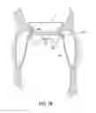 Fig. 16 - Transcatheter valve prosthesis
