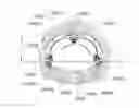 Fig. 01 - Medical device, kit and method for constricting tissue or a bodily orifice, for example, a mitral valve