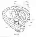 Fig. 20 - Medical device, kit and method for constricting tissue or a bodily orifice, for example, a mitral valve