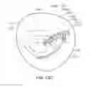 Fig. 37 - Medical device, kit and method for constricting tissue or a bodily orifice, for example, a mitral valve
