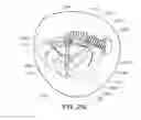 Fig. 45 - Medical device, kit and method for constricting tissue or a bodily orifice, for example, a mitral valve