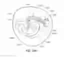 Fig. 50 - Medical device, kit and method for constricting tissue or a bodily orifice, for example, a mitral valve
