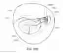 Fig. 53 - Medical device, kit and method for constricting tissue or a bodily orifice, for example, a mitral valve