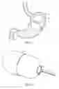 Fig. 02 - Pressure control system for intragastric device