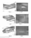 Fig. 11 - METHODS AND COMPOSITIONS FOR BONE AND CARTILAGE REPAIR