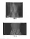 Fig. 17 - METHODS AND COMPOSITIONS FOR BONE AND CARTILAGE REPAIR