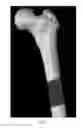 Fig. 02 - Osteoconductive and osteoinductive implant for augmentation, stabilization, or defect reconstruction